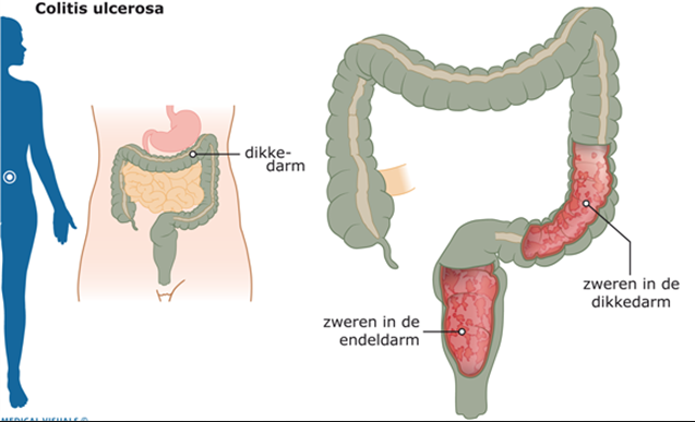DE ANATOMIE EN PATHOLOGIE VAN DE DARM: INFLAMMATOIRE DARMZIEKTEN - Waar Zit Je Dikke Darm