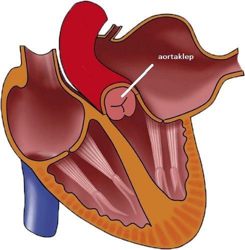 de aortaklep - Vernauwing Aorta In De Buik