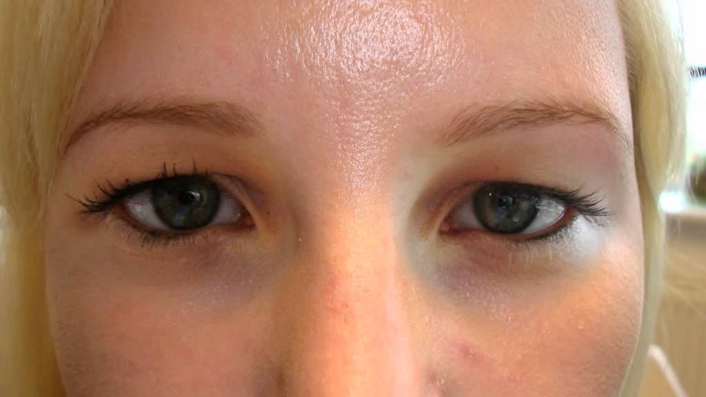 Wazig Zien Met 1 Oog