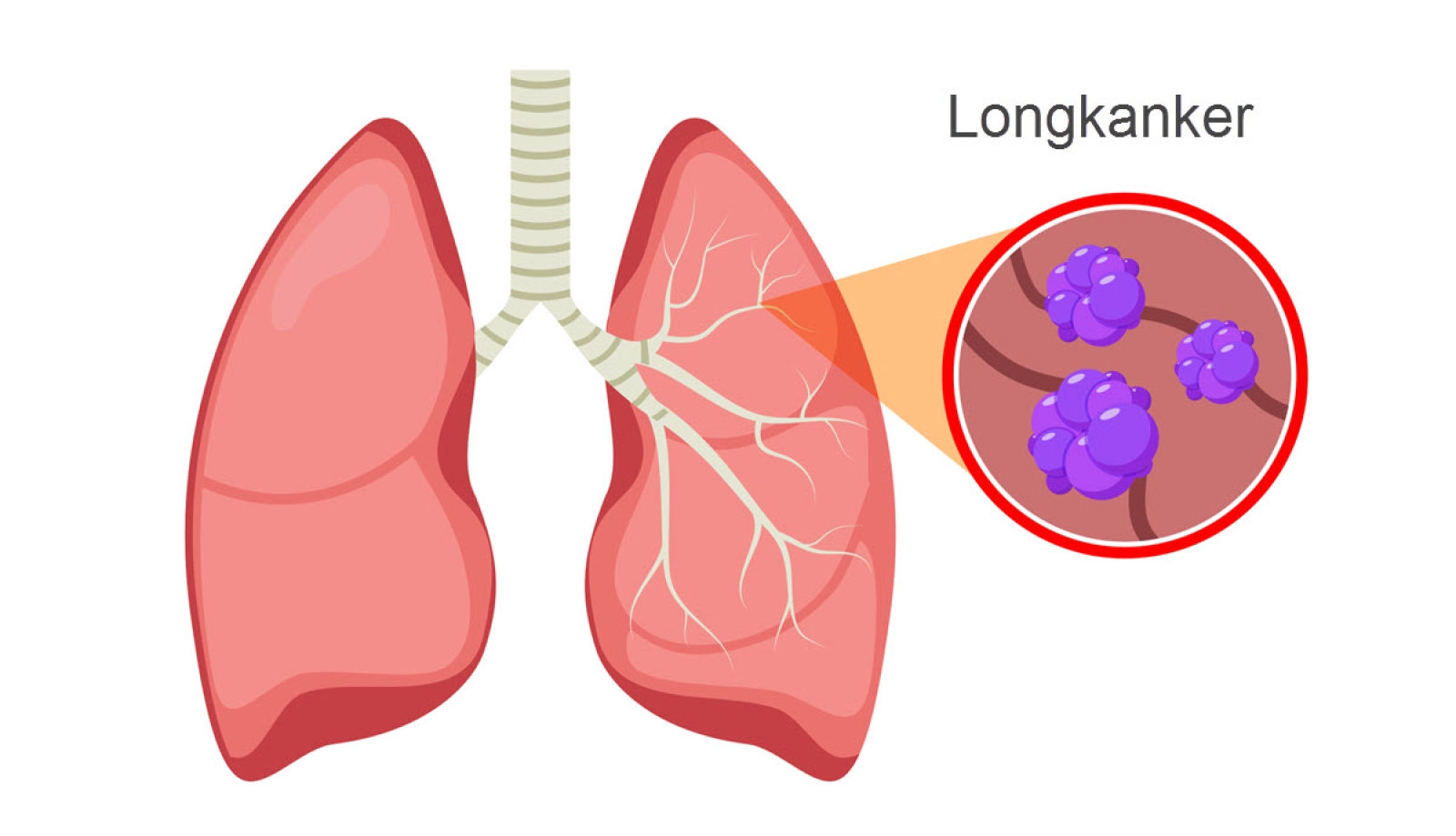 De ziekte longkanker - Slingeland Ziekenhuis - Hoelang Voordat Nicotine Uit Je Lichaam Is