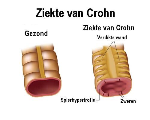 De ziekte van crohn symptomen en behandeling – Artofit - Wat Is De Ziekte Van Kroon