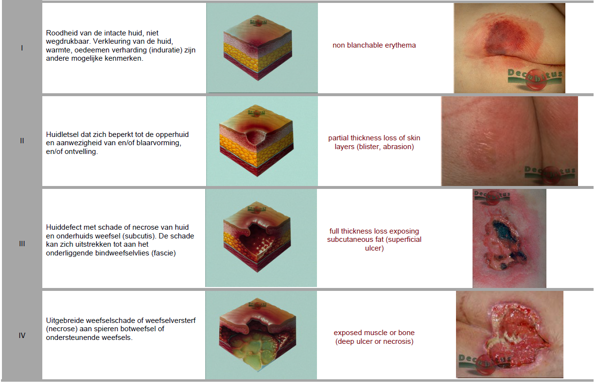 decubitus - DrBeckmann - Decubitus Graad 5 En 6