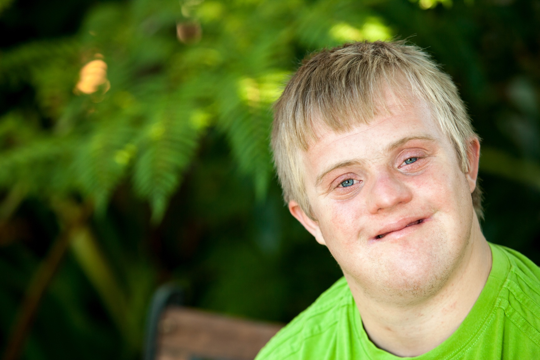 Dementia and Down Syndrome - Livewell Estates | Dementia and Alzheimer - Syndroom Van Down En Dementie