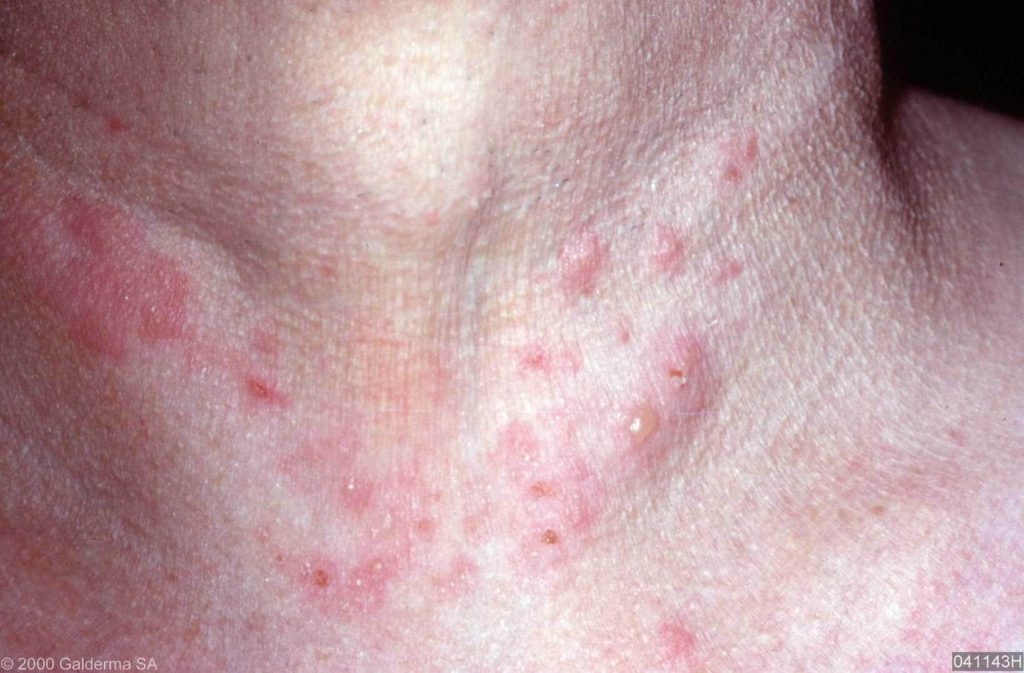 Dermatitis Herpetiforme - Bultjes In Nek En Hals