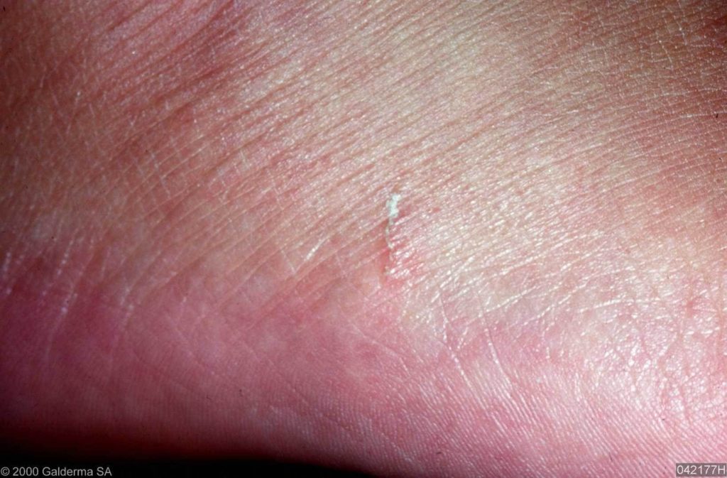 dermatoscopy - pictures, photos - Wat Is Schurft En Hoe Ziet Het Eruit
