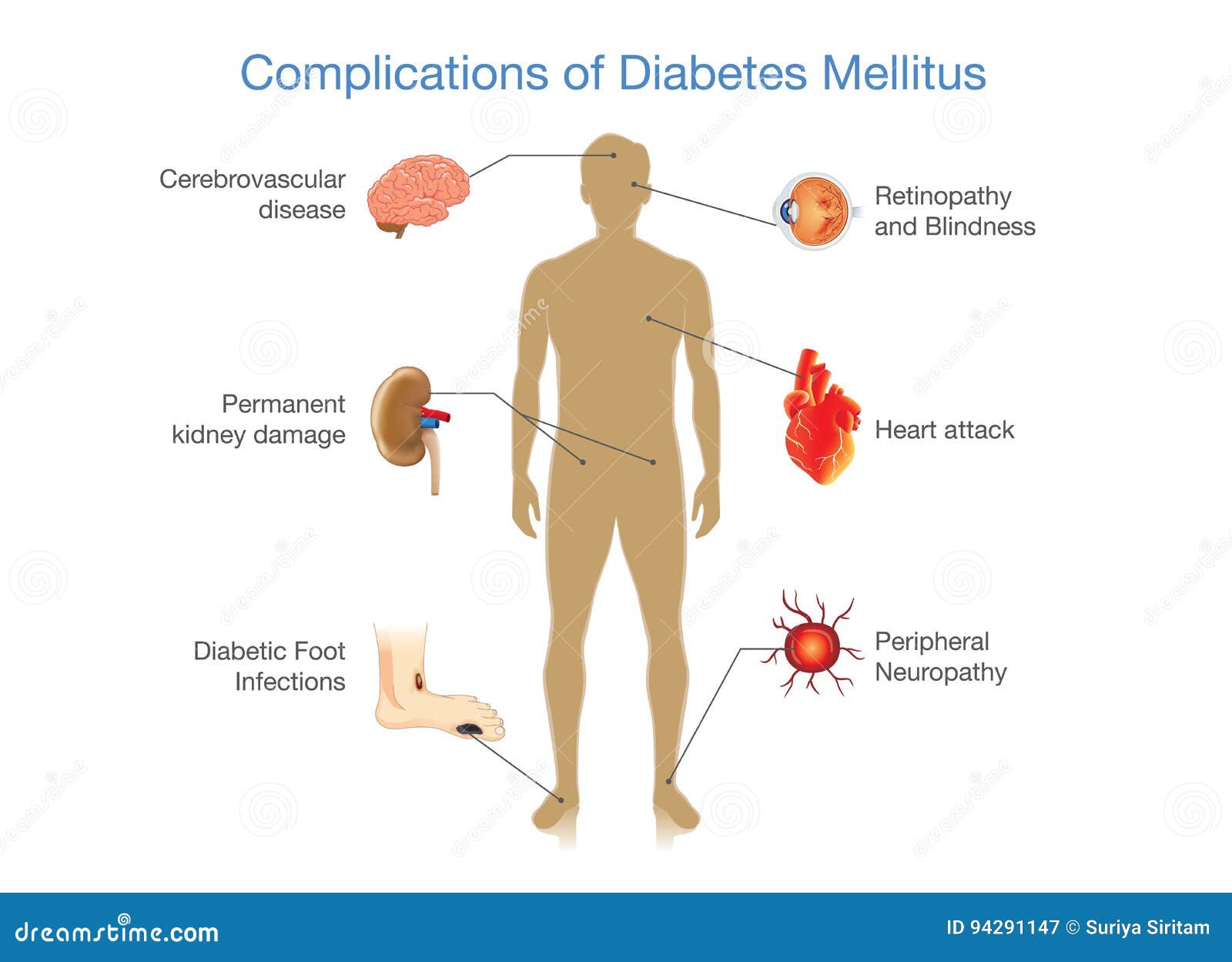 Diabetes Mellitus Affected Organs Cartoon Vector | CartoonDealer.com - Gevolgen Diabetes Type 1 Lange Termijn