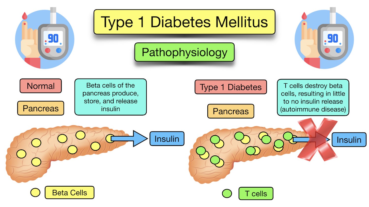 Diabetes Pathophysiology Diagram Flow Pathophysiology Mellit - Wat Is Een Auto Immuun Ziekte