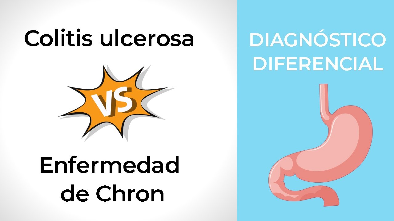 Verschillen Crohn En Colitis Ulcerosa