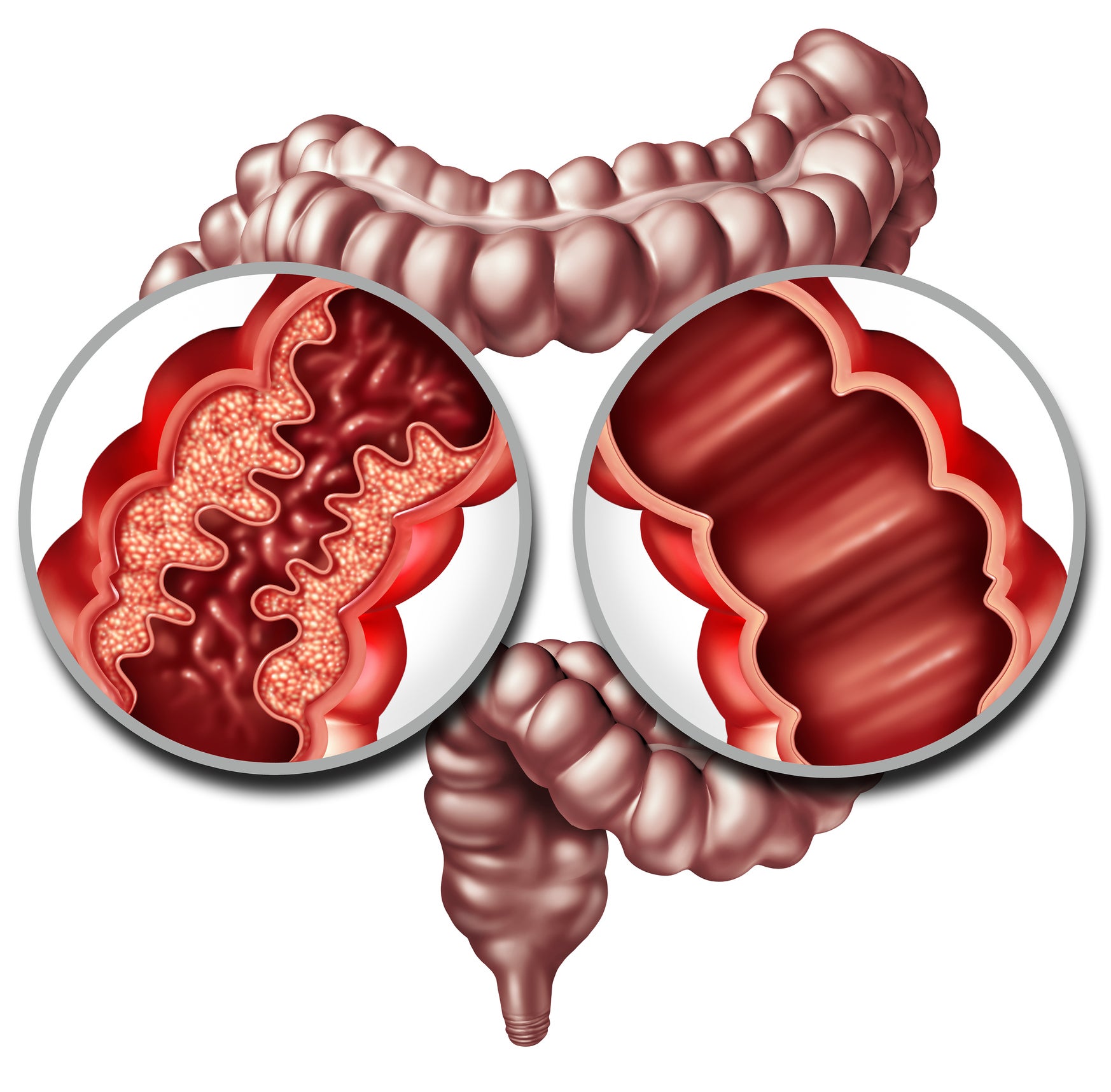 Diferencias entre colitis y gastritis, ¡identifícalas antes de que te - Colitis Ulcerosa En Crohn Verschil