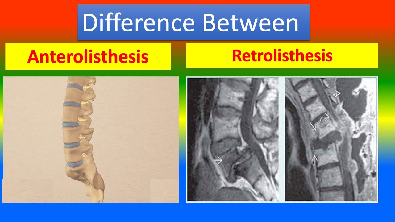 Anterolisthesis Graad 1 Van L4 En L5