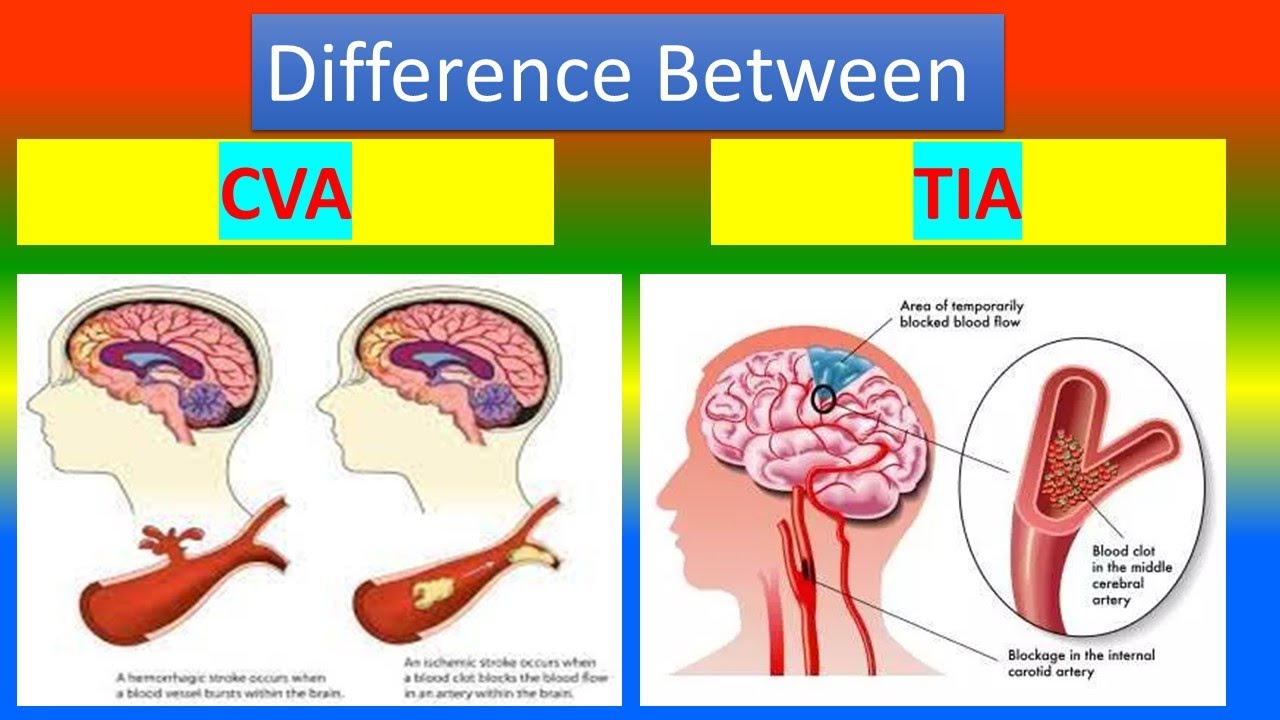 Difference between CVA and TIA - YouTube - Wat Is Erger Herseninfarct Links Of Rechts
