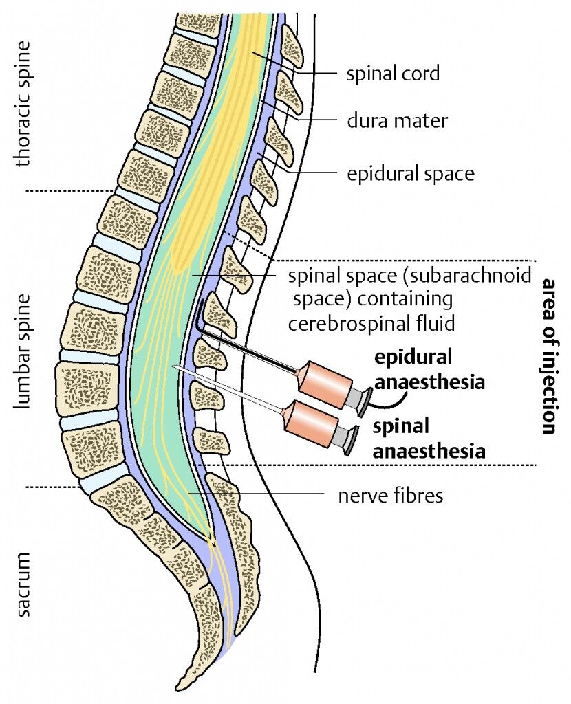 Difference between epidural and spinal injection's | Epidural, Spinal - Verschil Spinale En Epidurale Anesthesie