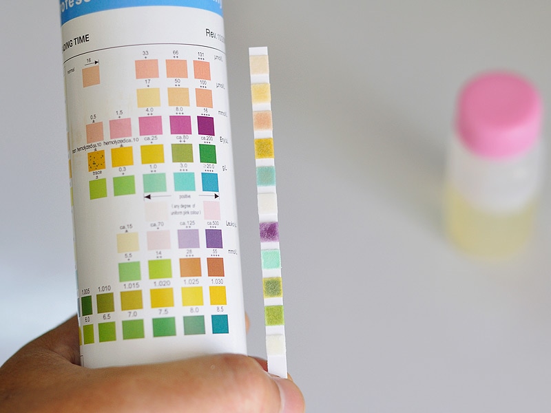 Dipstick Test Effective Initial Screen for UTI in Infants - Eiwit In Urine Bij Blaasontsteking
