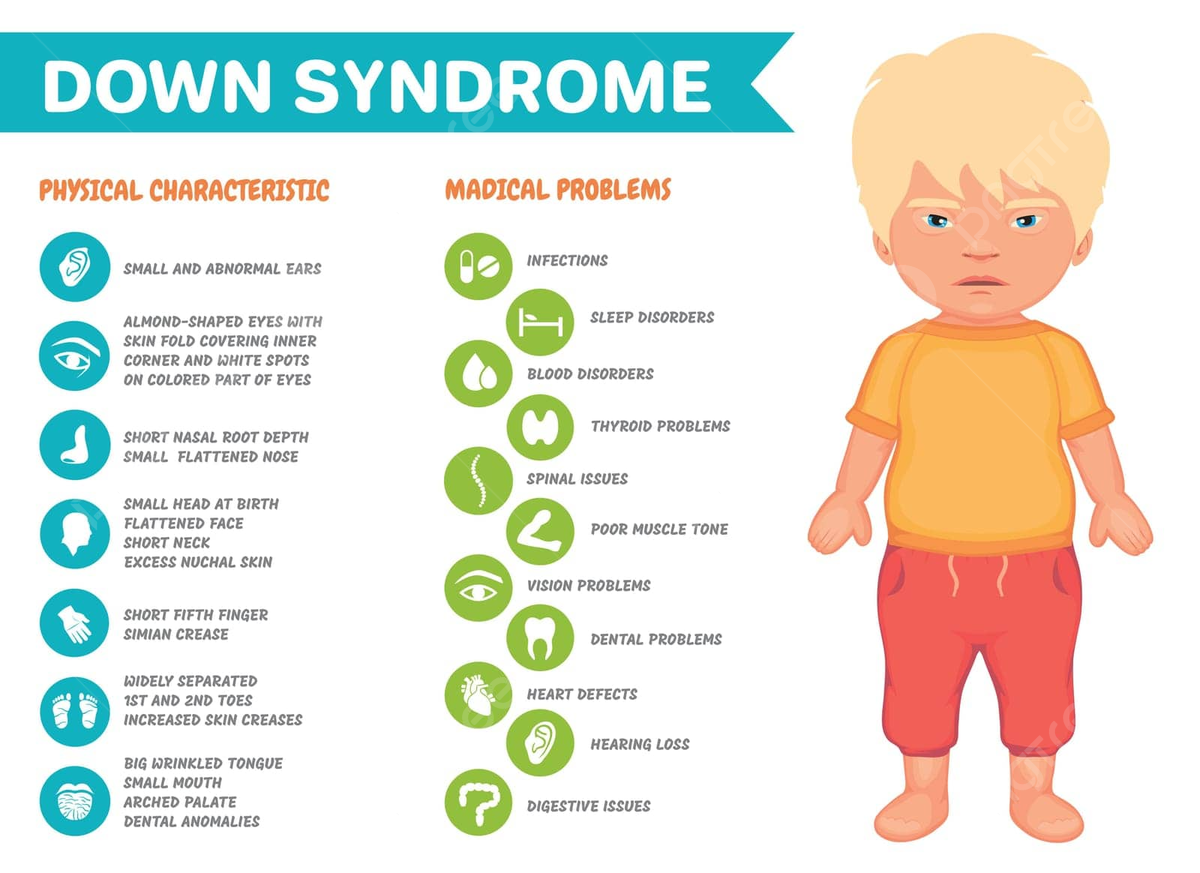 Down Syndrome Monkey - Kenmerken Van Het Syndroom Van Down