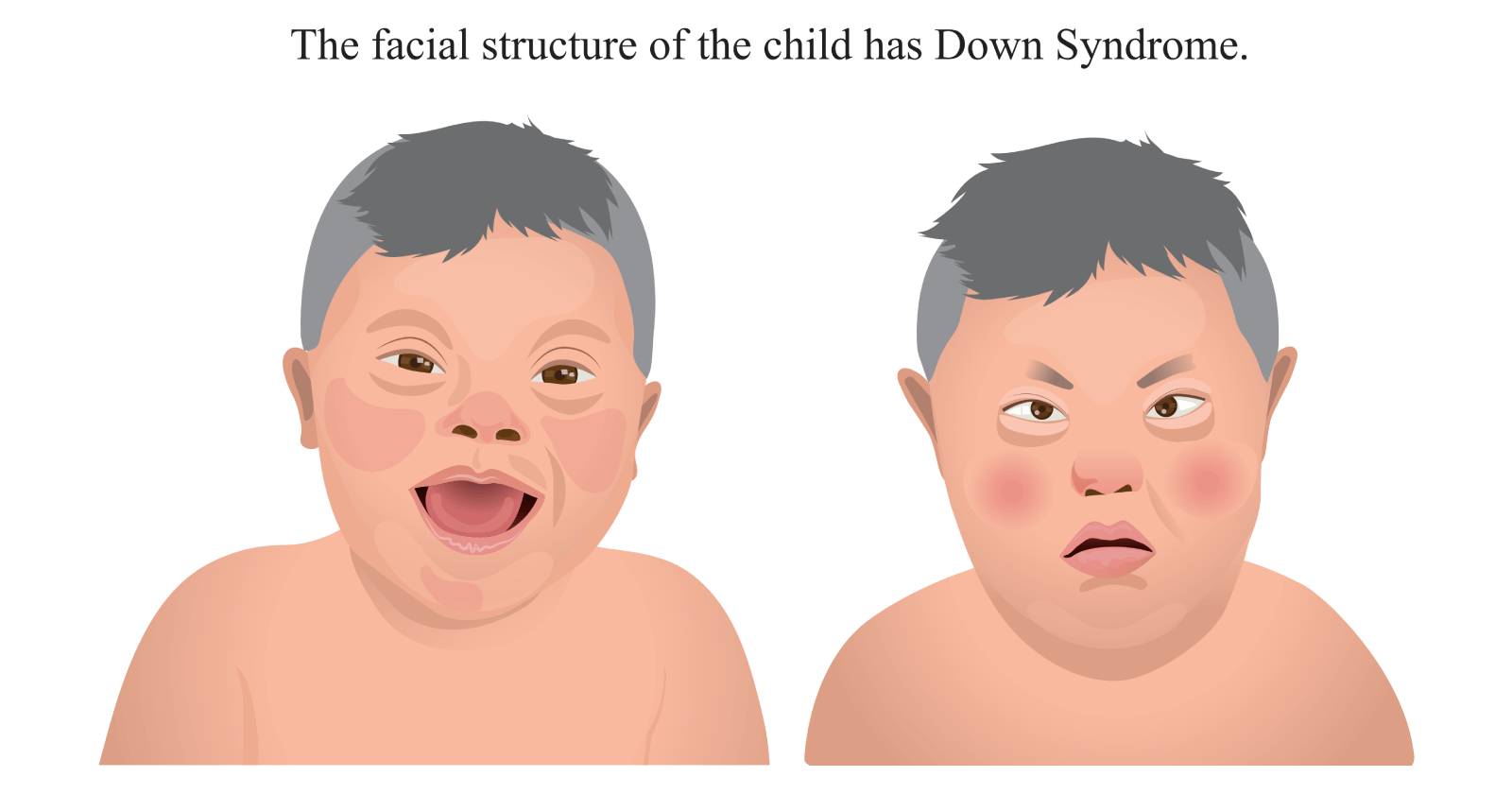 Down Syndrome: Symptoms, Causes, Prevention and Treatments - Syndrome De Gilles De La Tourette