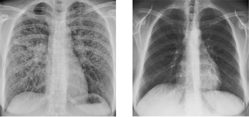 drug induced - pictures, photos - Wat Is Een Infiltraat In De Longen