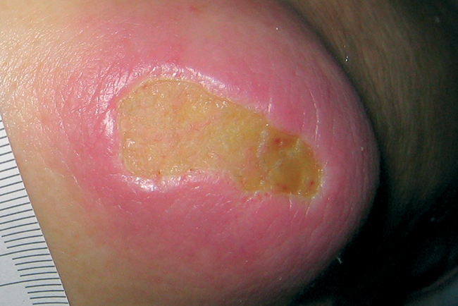 Dry Fibrinous Wounds - Gele Wond Met Fibrine Behandeling