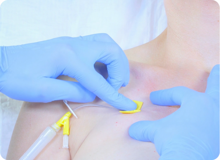 e-Xpert VBH: Suprapubische katheter (2019) - ExpertCollege.nl - Katheter Vervangen Bij Blaasontsteking Vilans