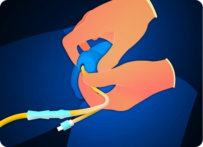 e-Xpert VVT: Blaaskatheterisatie man - ExpertCollege.nl - Wat Is Een Indicatie Voor Blaaskatheterisatie