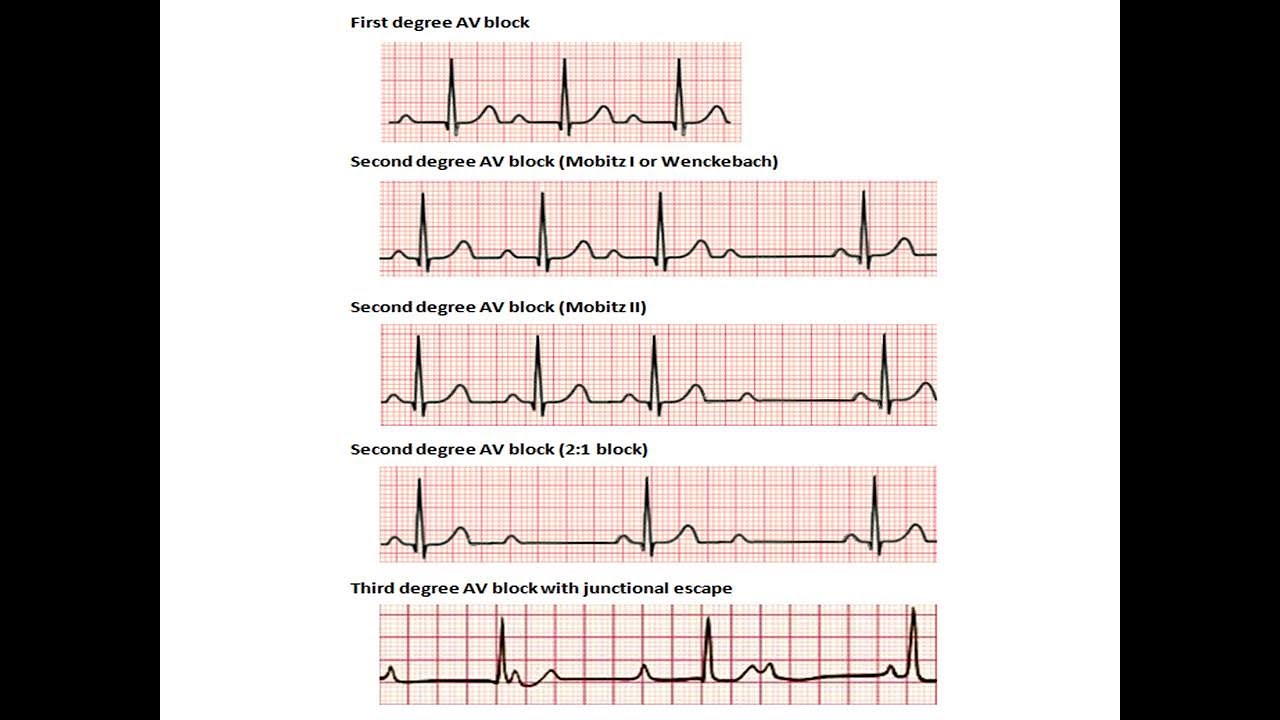 ECG course: AV blocks, Dr. Sherif Altoukhy - YouTube - 3e Graads Av Blok Ecg