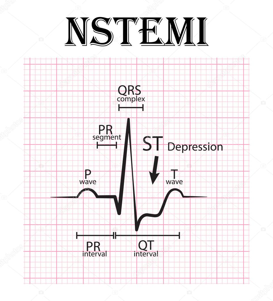ECG of non ST elevation myocardial infarction (NSTEMI) and detail of - Acuut Myocardinfarct Zonder St Elevatie