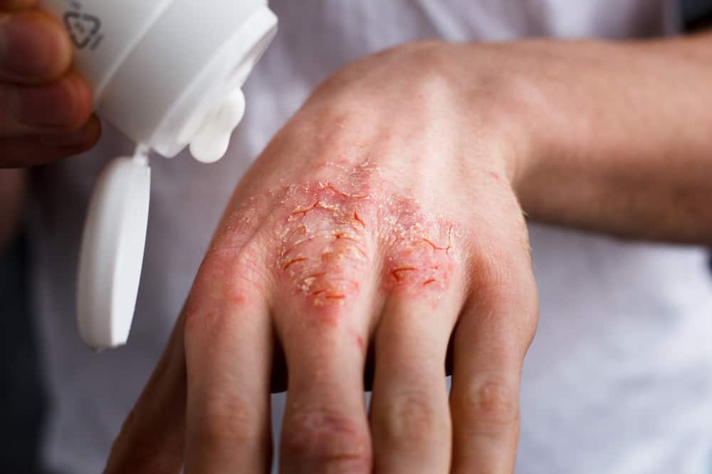Eczema Treatment: The Best Options and Home Remedies for Eczema - Verschil Tussen Zalf En Creme