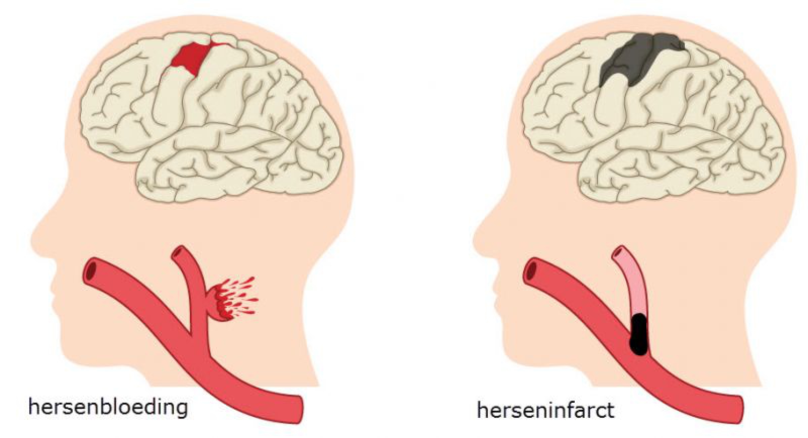 Wat Is Het Verschil Tussen Een Tia En Een Herseninfarct