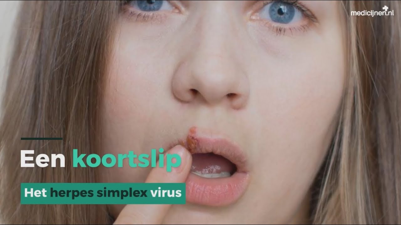 Wanneer Koortslip Niet Meer Besmettelijk