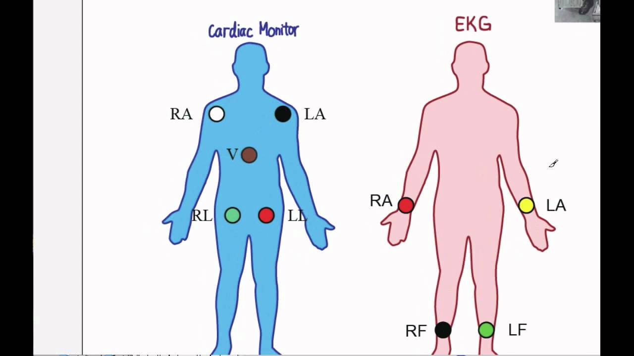 Hoe Ziet Een Normale Ecg Eruit