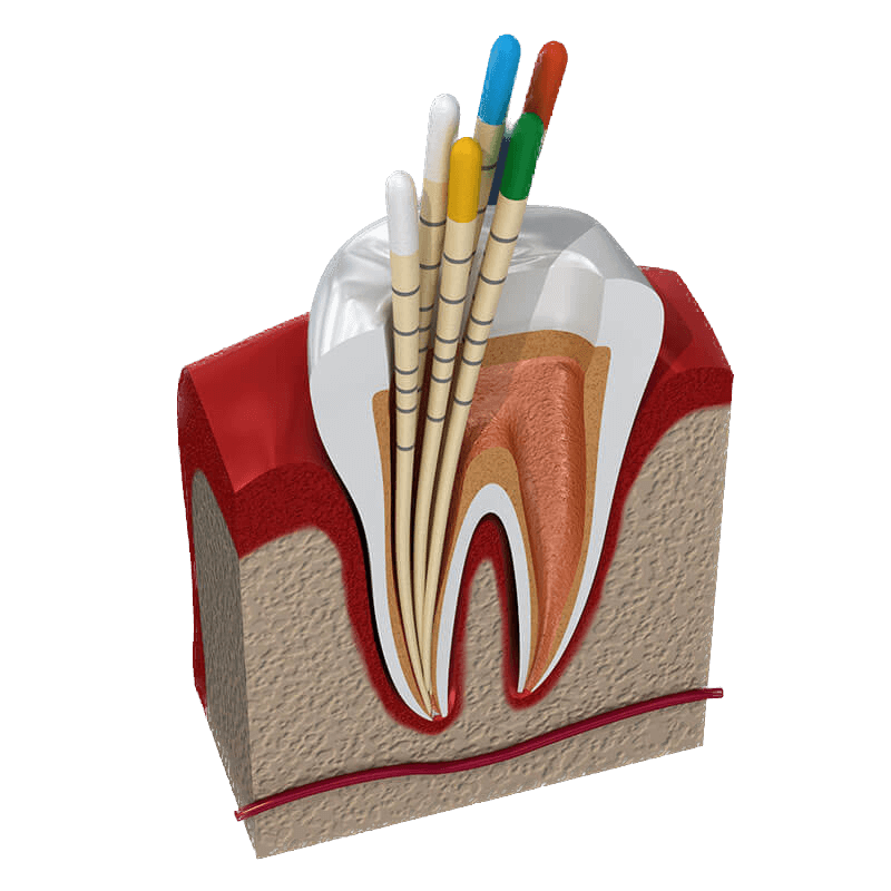 "ENDO: Top Wortelkanaalbehandeling bij Dental Benelux - Fistel Op Tandvlees Na Wortelkanaalbehandeling