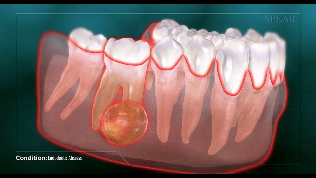 Endodontic Abscess - YouTube - Hoe Ziet Een Abces In De Keel Eruit
