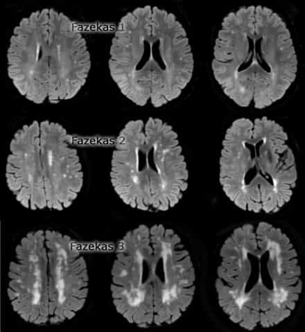 Enfermedad cerebrovascular | Institut Chiari de Barcleona - Fazekas Graad 1 Witte Stofafwijkingen