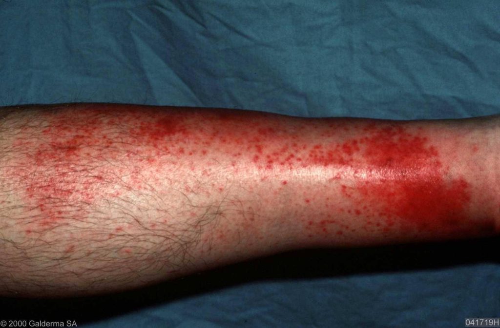 Erysipelas - Pictures - Infectie In Het Bloed Symptomen