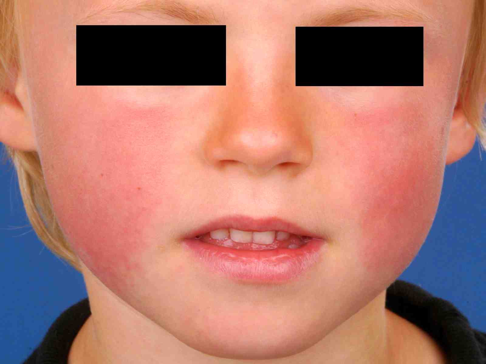 Erythema Infectiosum Practice Essentials Background - Hoge Koorts En Rode Vlekken