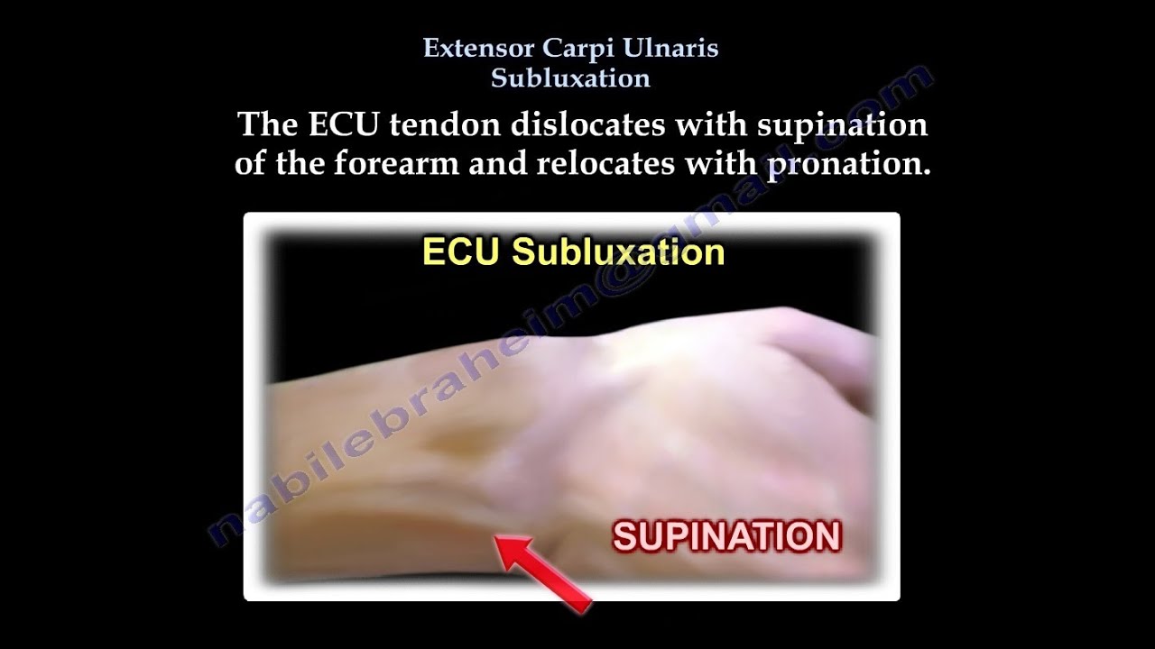 Extensor Carpi Ulnaris Subluxation - Everything You Need To Know - Dr - Extensor Carpi Ulnaris Tendinopathie Oefeningen