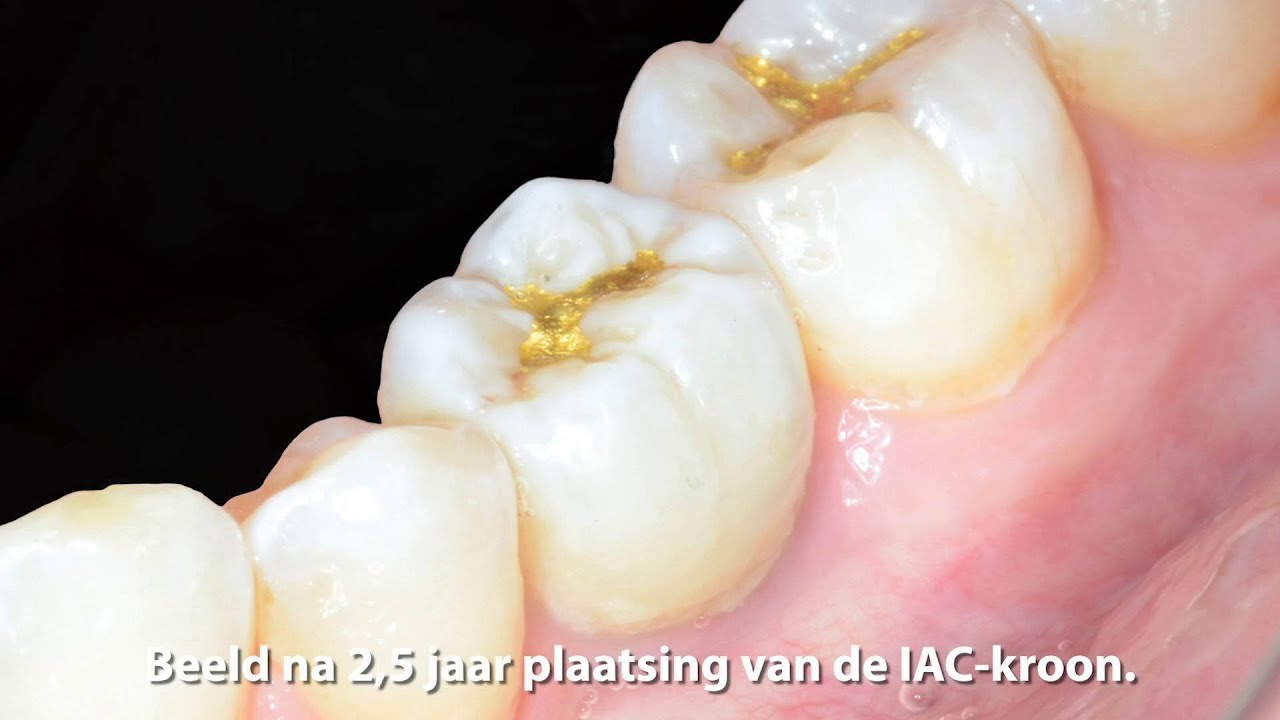Fistel Op Tandvlees Na Wortelkanaalbehandeling