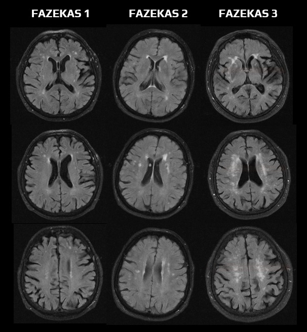 FAZEKAS scale | STROKE MANUAL - Fazekas Graad 1 Witte Stofafwijkingen