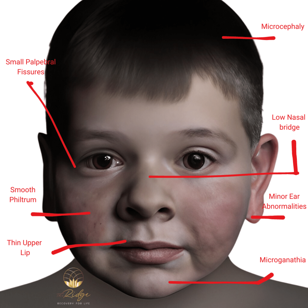 Fetal Alcohol Syndrome: Understanding its Causes, Symptoms, and - Foetaal Alcohol Syndroom Uiterlijke Kenmerken