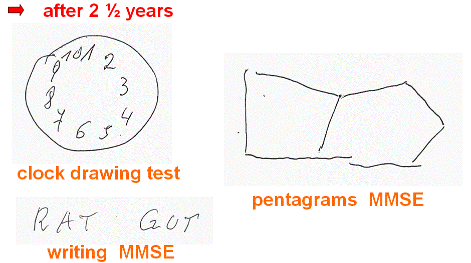 Figure 3 | Mini Mental State Examination MMSE: 6 points Severe.. - Wat Is Een Mmse Test