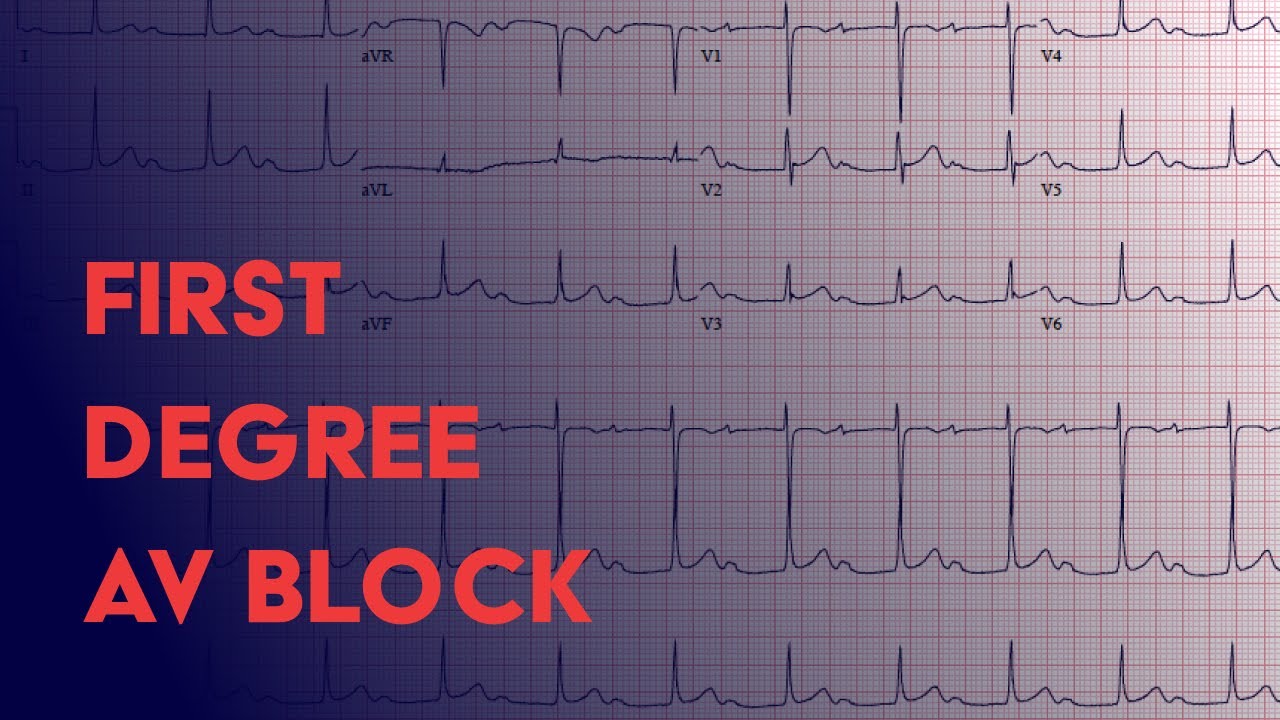1e Graads Av Blok Ecg