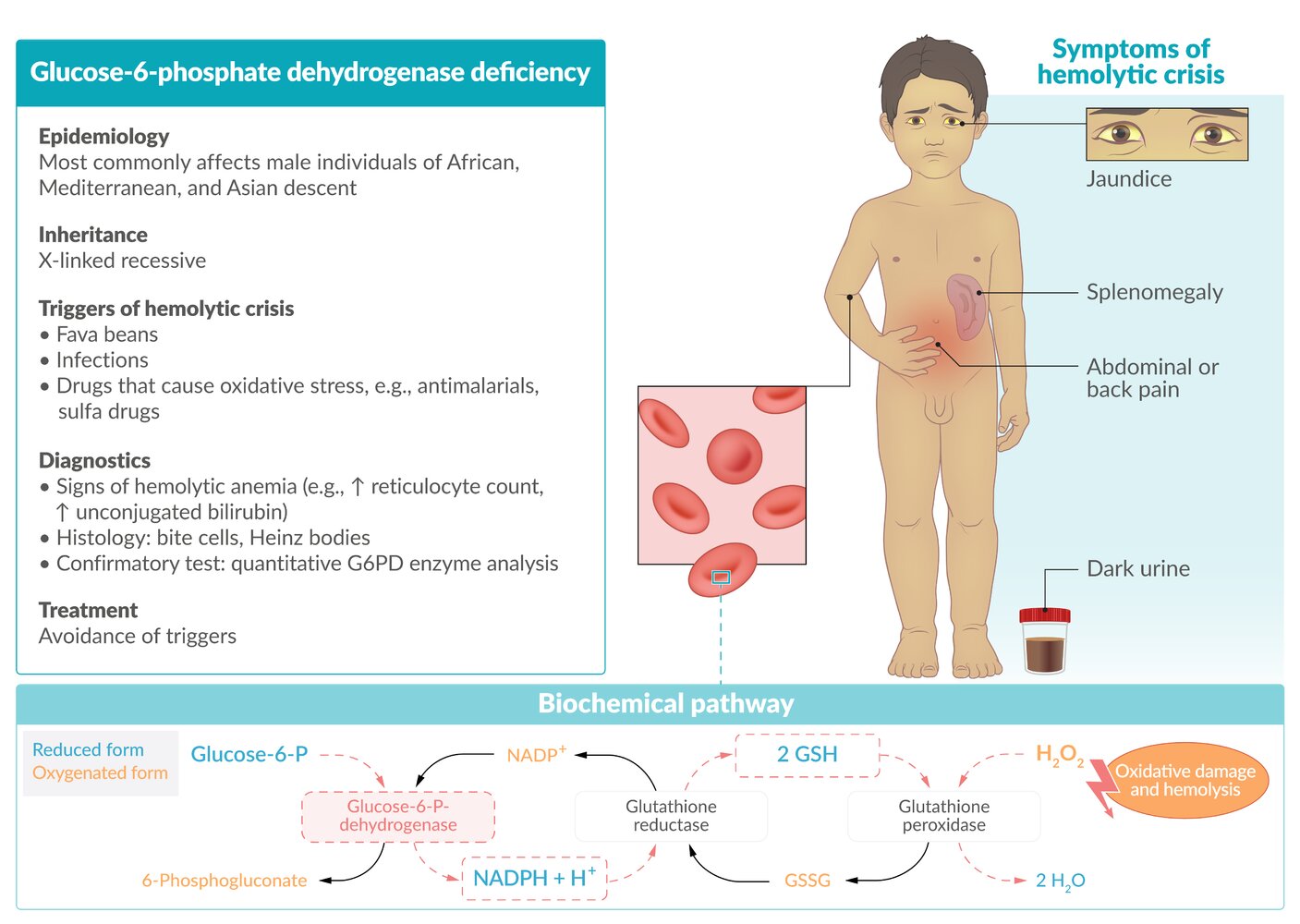 G6PD Deficiency: Symptoms, Diagnosis, And Treatment Options, 45% OFF - Glucose 6 Fosfaat Dehydrogenase Deficientie