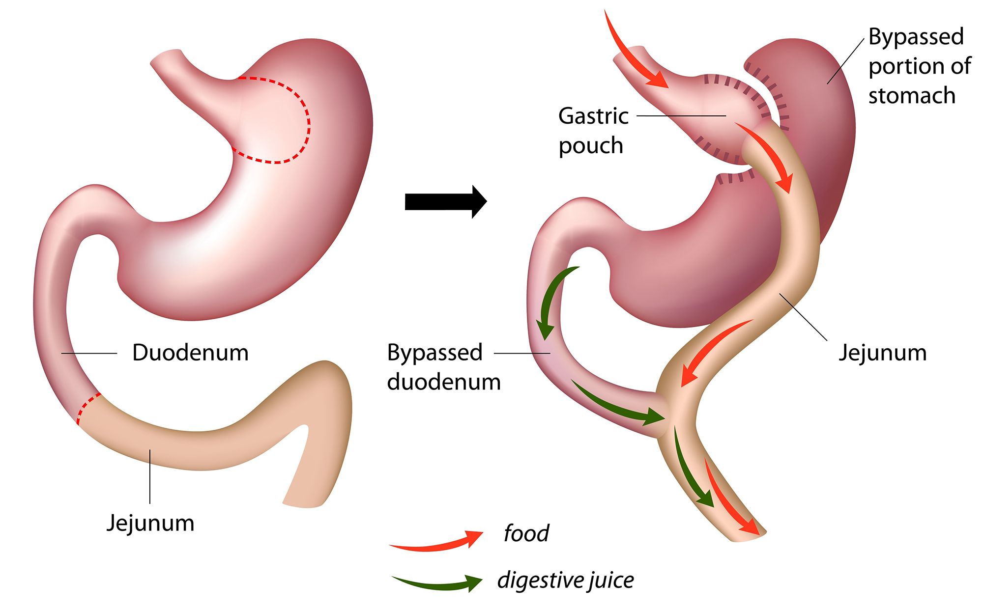 Gastric Bypass - Hevige Buikpijn Na Gastric Bypass
