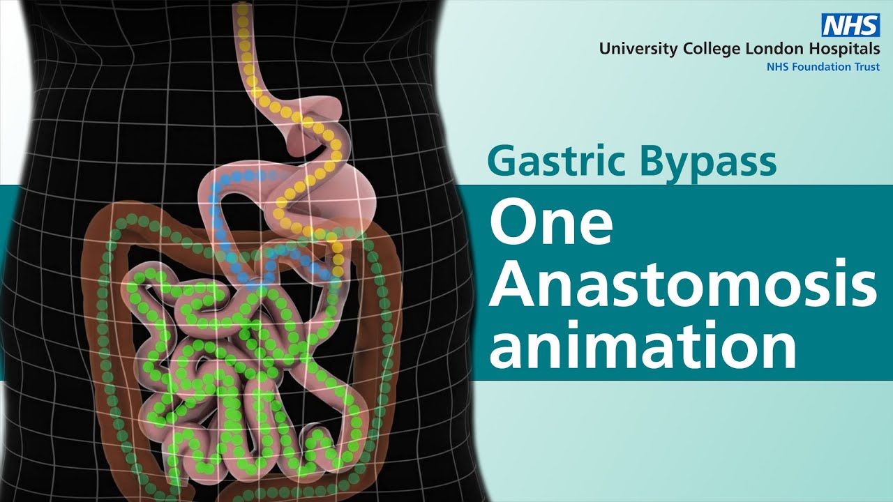 Hevige Buikpijn Na Gastric Bypass