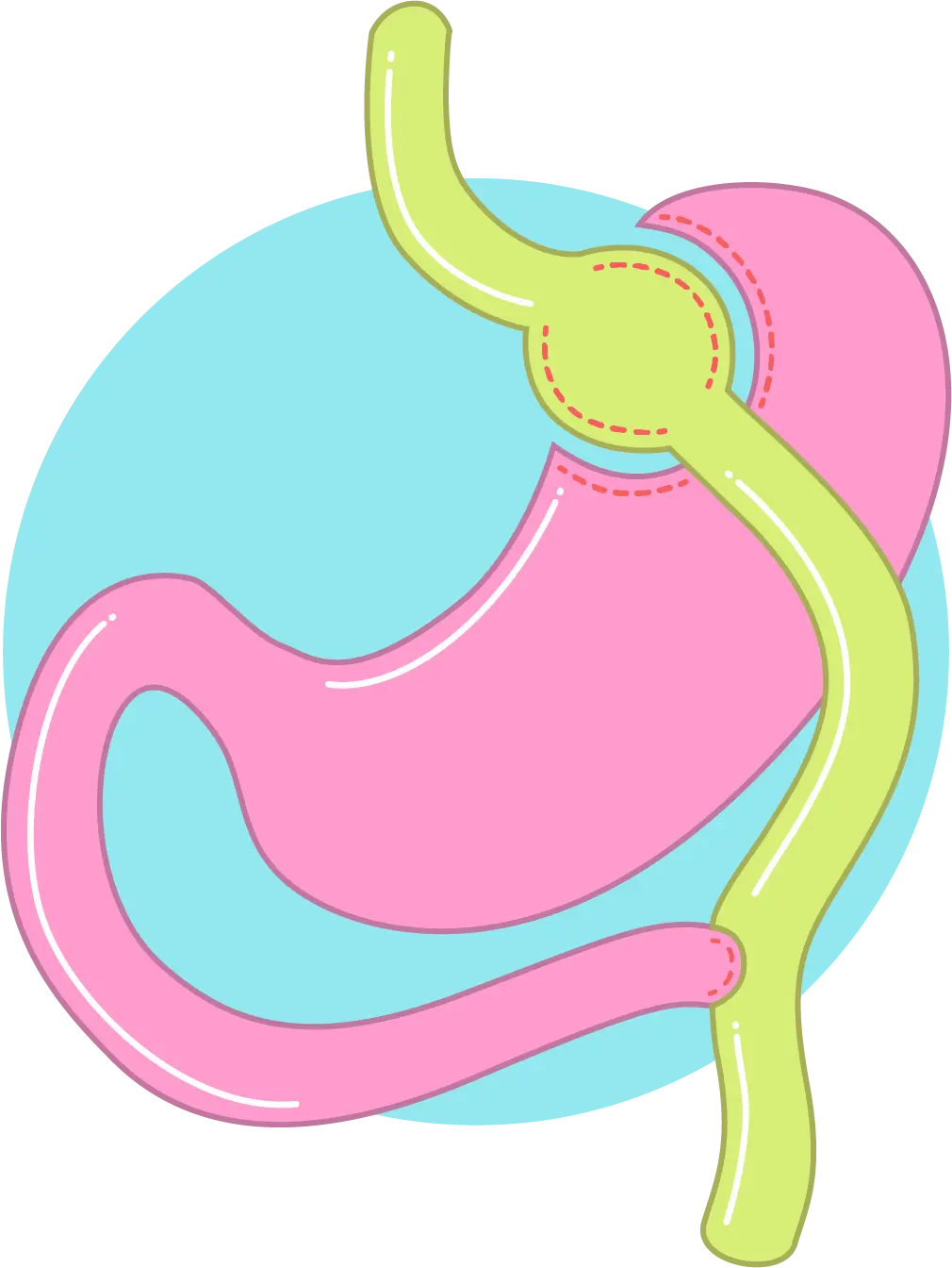 Gastric Bypass - phorma - Hevige Buikpijn Na Gastric Bypass