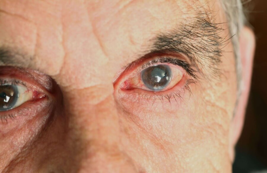 Glaucoom behandeling met laser in plaats van oogdruppels? - In Welk Lichaamsdeel Laat Je Oogdruppels Precies Vallen