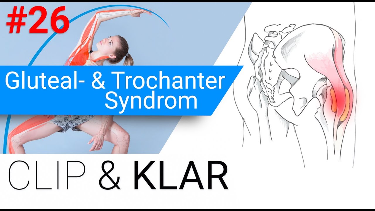 Gluteal- & Trochanter Syndrom erklärt - Entzündung am grossen Rollhügel - Hoe Lang Duurt Trochanter Major Pijnsyndroom
