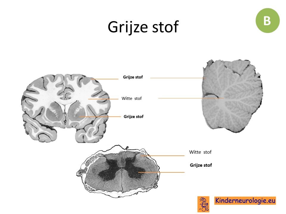 Grijze stofziekten - Kinderneurologie - Aspecifieke Witte Stof Afwijkingen Hersenen