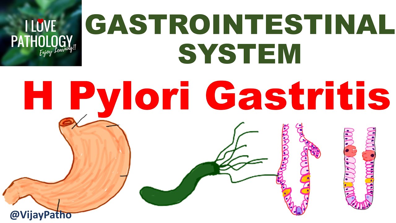 Hoe Krijg Je Helicobacter Pylori