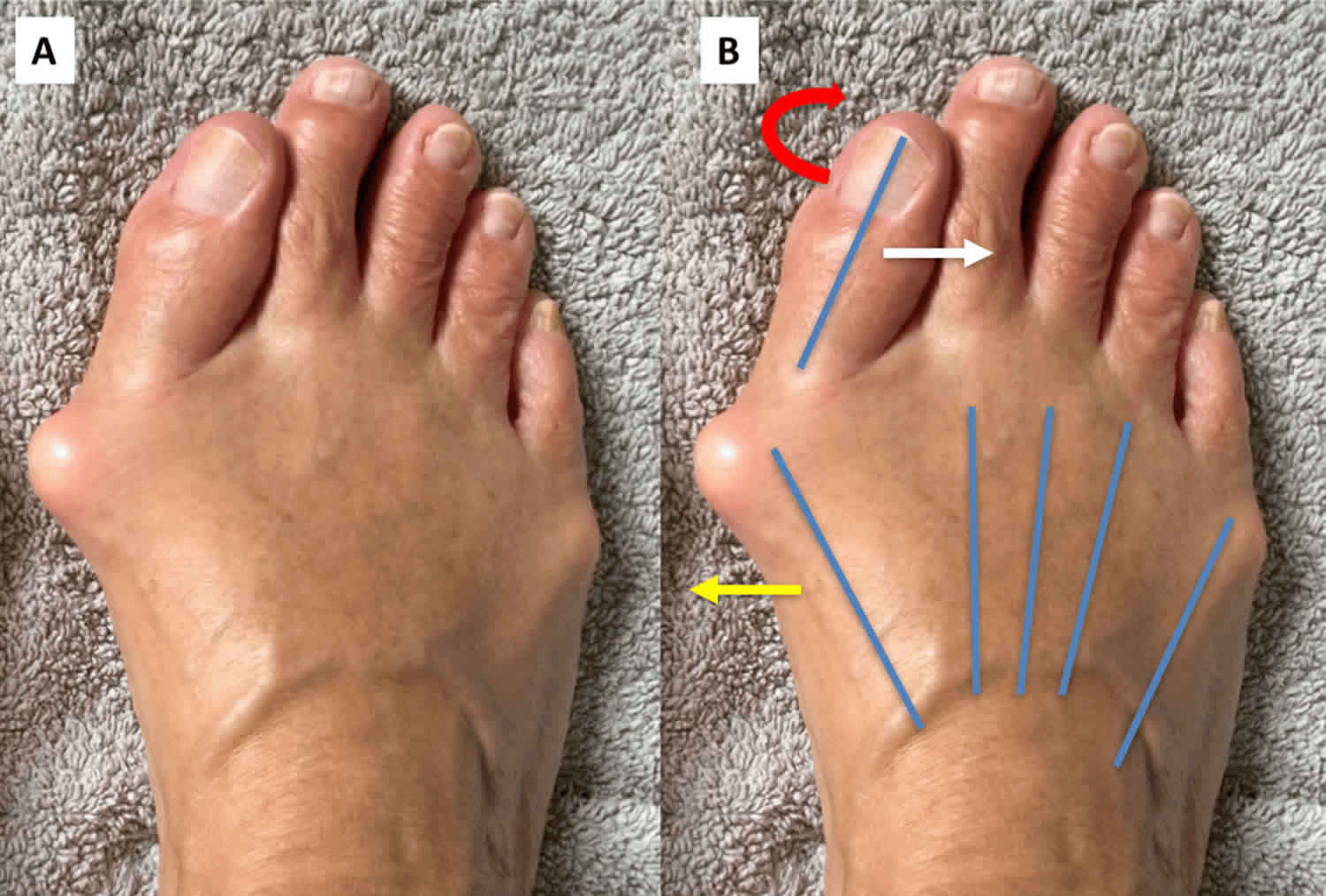 Hallux valgus deformity causes, hallux valgus bunion & treatment - Valgus En Varus Stress Test