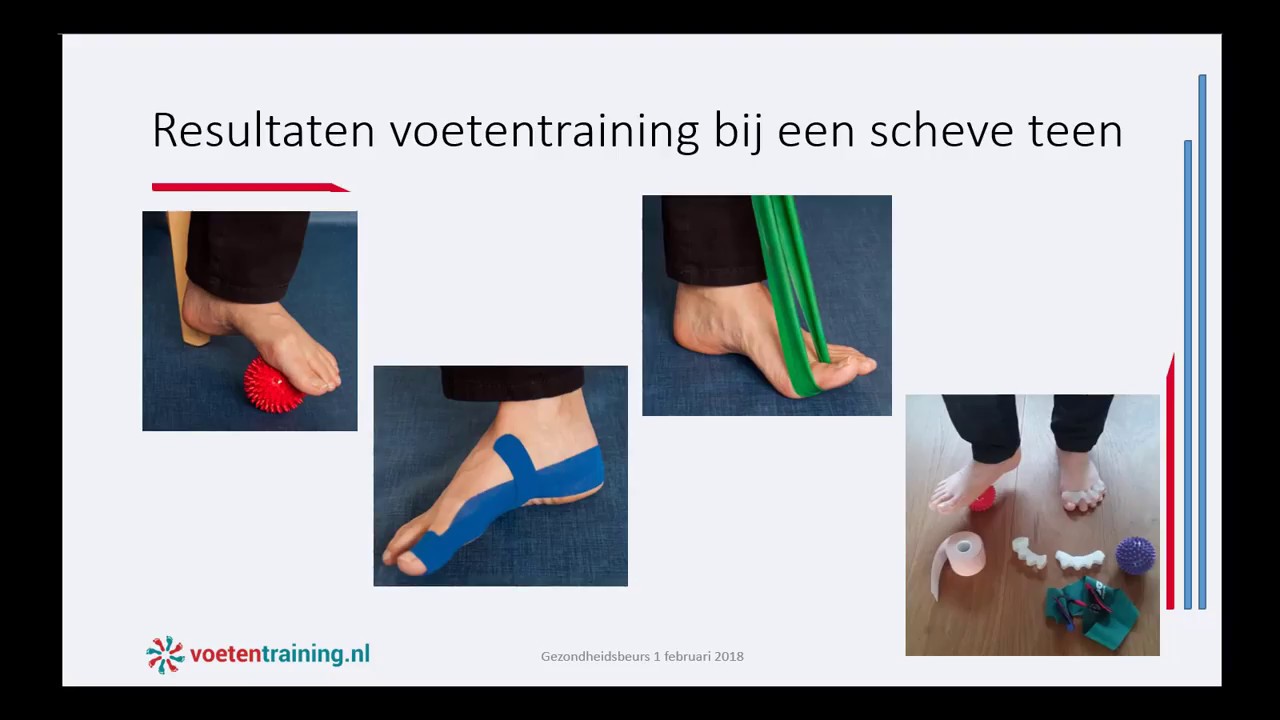 Hallux valgus voetentraining werkt! - YouTube - Hoeveel Botjes Zitten Er In Je Voet